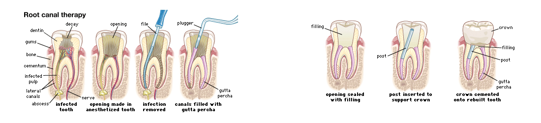 Root Canal Treatment in Panchkula